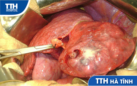 Phẫu thuật điều trị sỏi đường mật trong gan